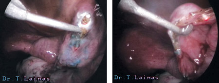 Salpingostomy: The hydrosalpinx is opened with the help of special hooks and laser CO2 (laparoscopic image).